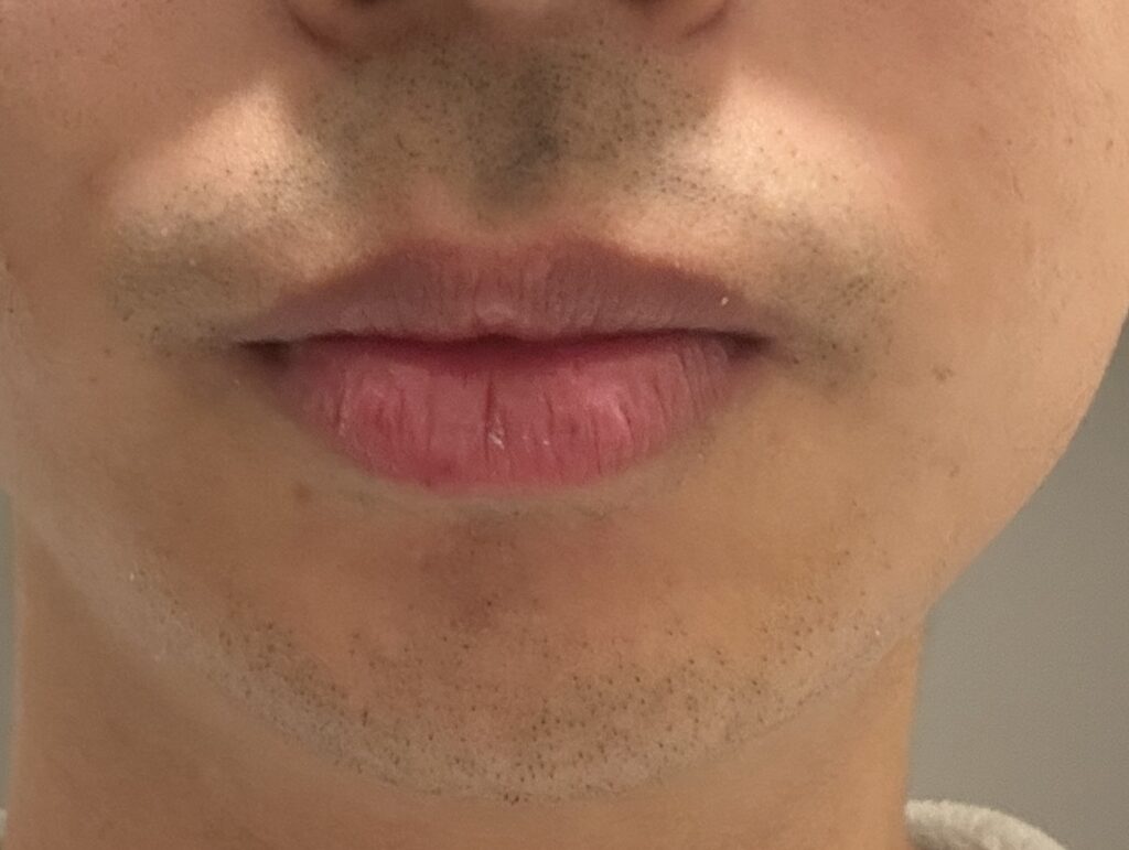 ヒゲ脱毛１回目から10日後のイラスト