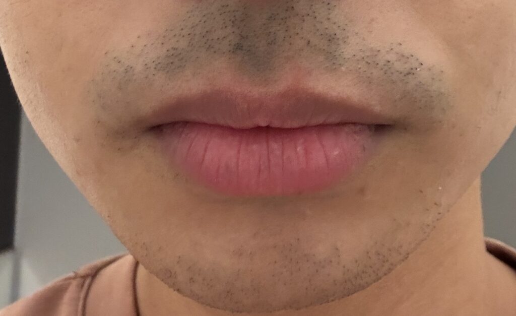 ヒゲ脱毛１回目から１日後のイラスト