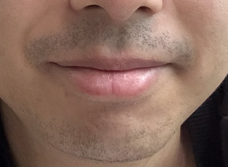 ヒゲ脱毛を始める前のヒゲの様子イラスト