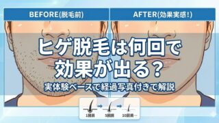 ヒゲ脱毛は何回で効果が出る?実体験ベースで経過写真付きで解説