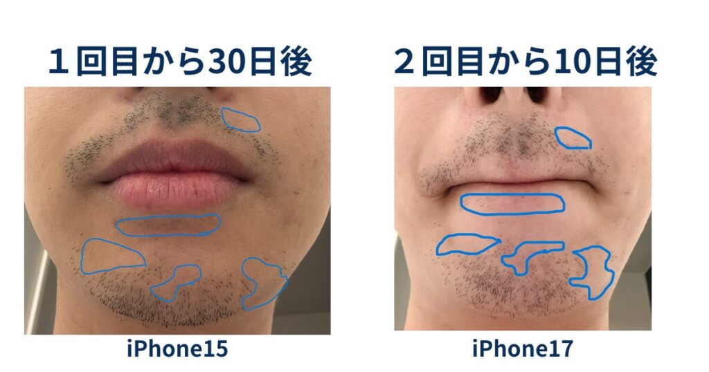 ヒゲ脱毛1回目の30日後と2回目の10日後の髭の生え方について比較したイラスト