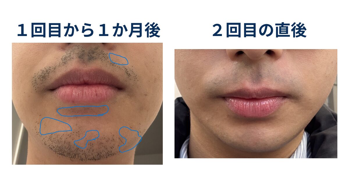 ヒゲ脱毛1回目の30日後と2回目の直後で痛みについて比較するイラスト