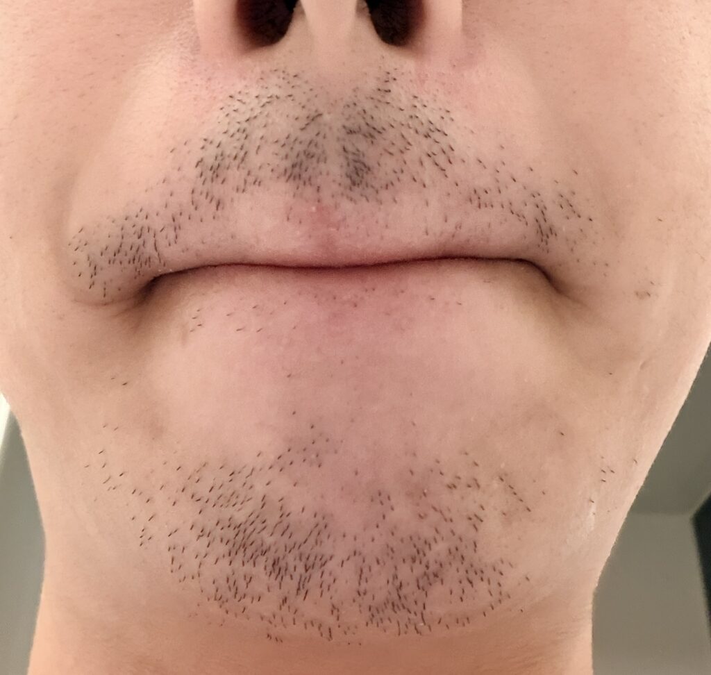 ヒゲ脱毛2回目の10日後の様子