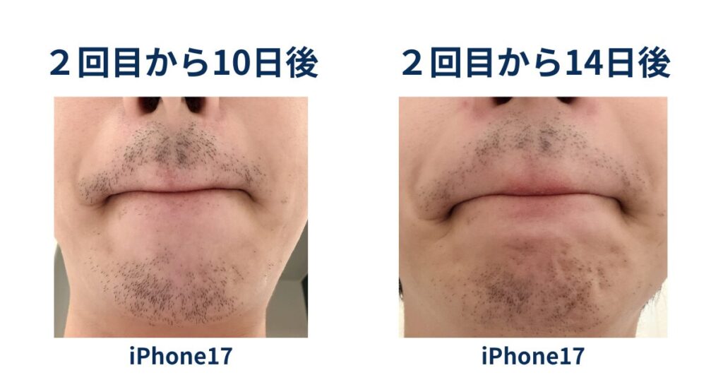 ヒゲ脱毛2回目の10日後と2回目の14日後の髭の生え方について比較したイラスト