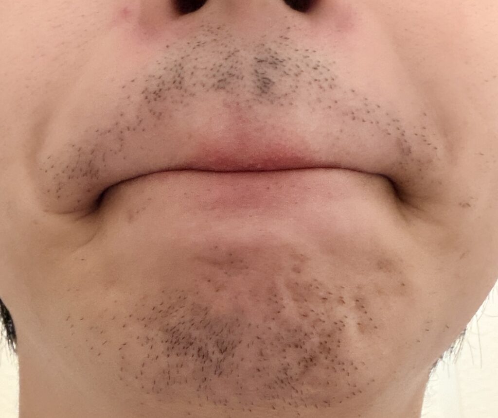 ヒゲ脱毛2回目の14日後の様子