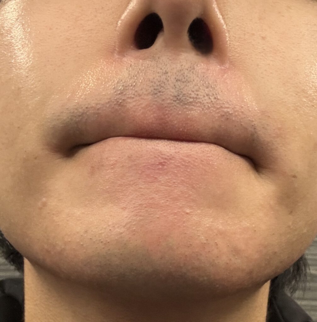 ヒゲ脱毛２回目直後のヒゲの様子