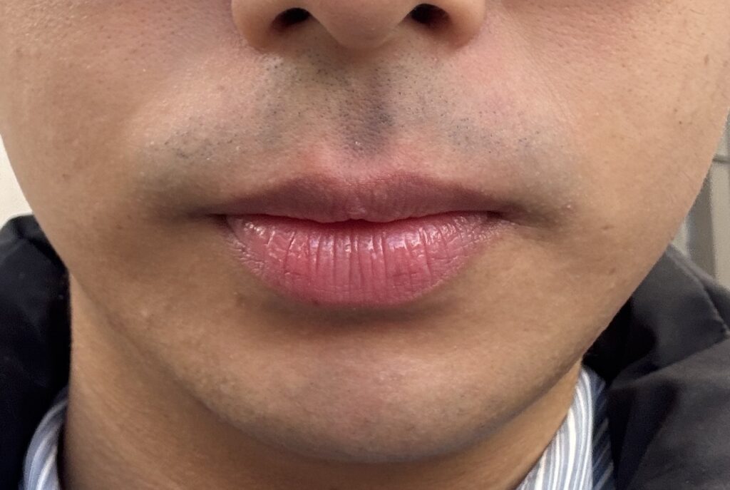 ヒゲ脱毛後の赤みを表したイラスト