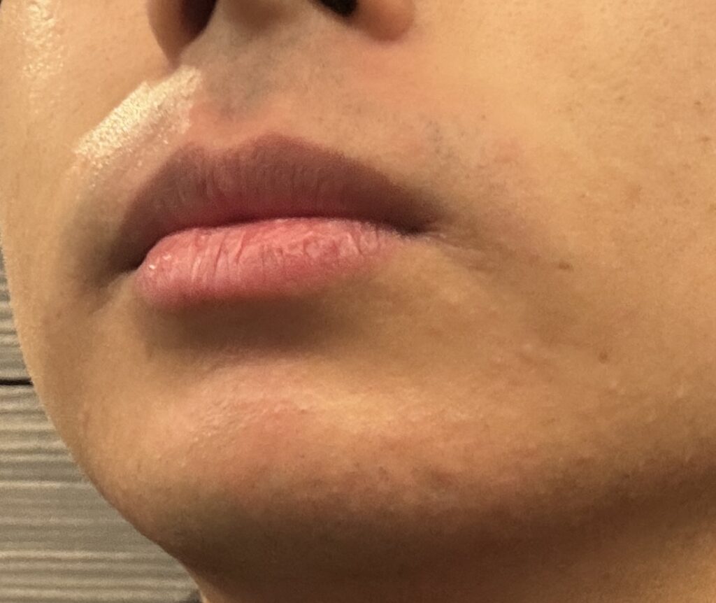 ヒゲ脱毛後の肌が赤くなる様子についてのイラスト