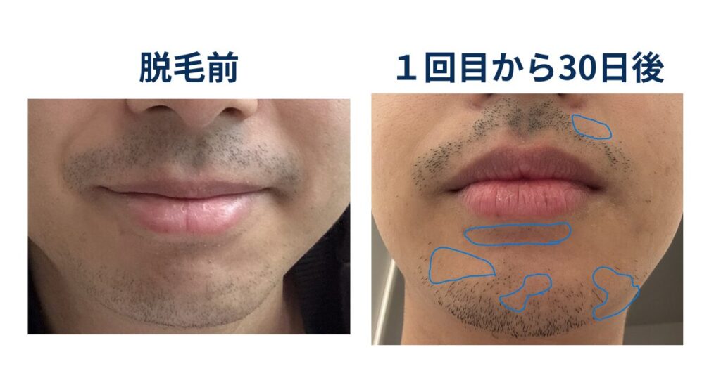 ヒゲ脱毛前とヒゲ脱毛から30日後の髭の様子を比較しているイラスト
