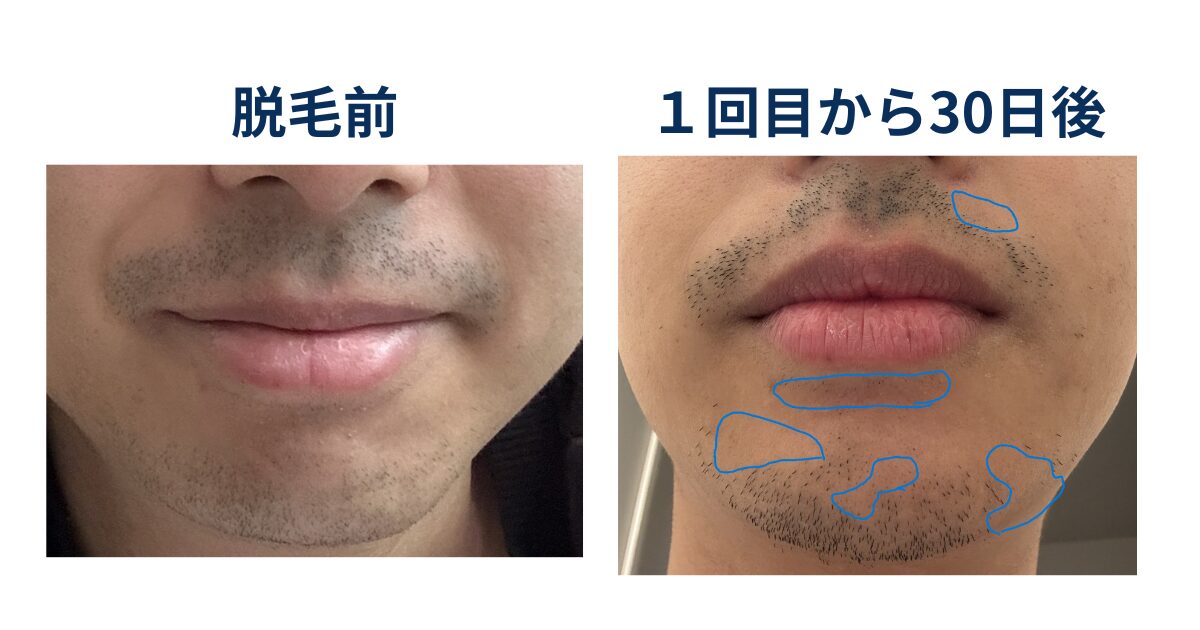 ヒゲ脱毛前とヒゲ脱毛から30日後の髭の様子を比較しているイラスト