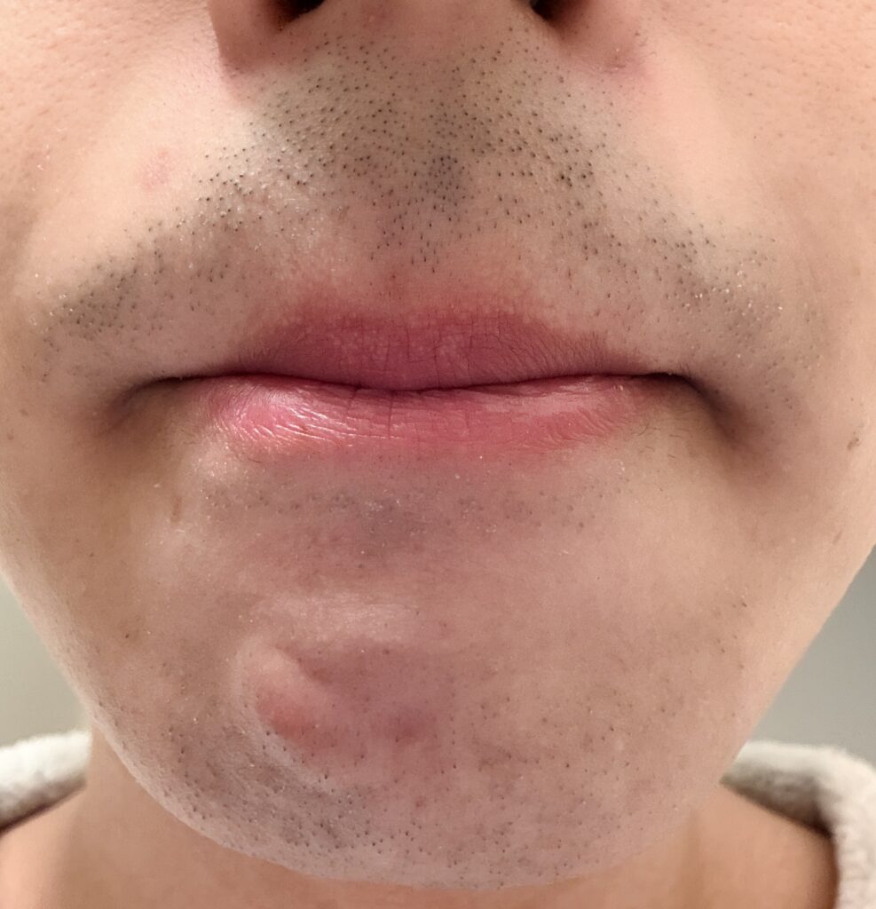 ヒゲ脱毛２回目から37日後のヒゲの様子のイラスト