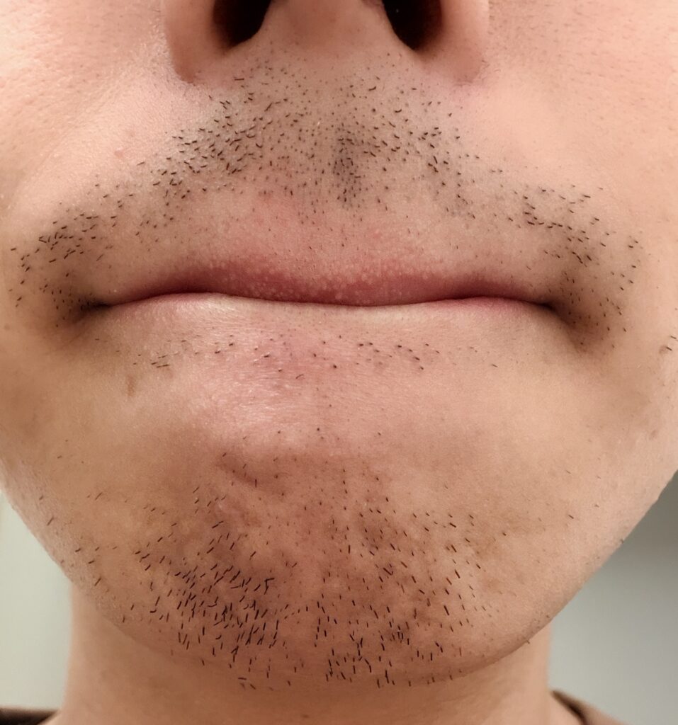 ヒゲ脱毛3回目から11日後のヒゲの様子を表すイラスト