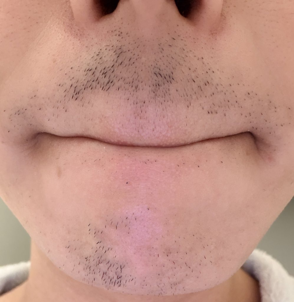 ヒゲ脱毛3回目から18日後のヒゲの様子を表すイラスト