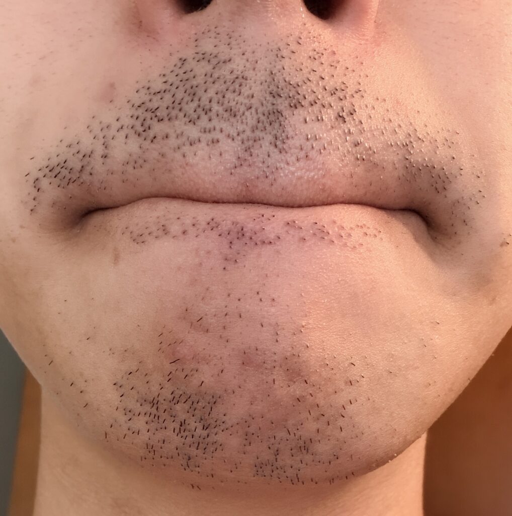 ヒゲ脱毛３回目から２日後のヒゲの様子を表すイラスト