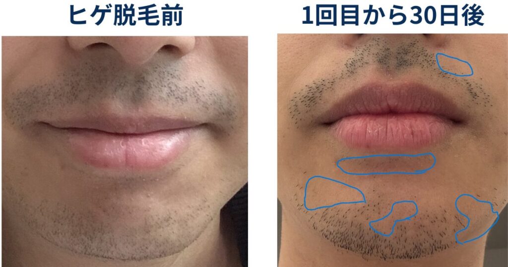 ヒゲ脱毛を始める前と1回目の30日後でヒゲがどのように変化しているか比較するイラスト