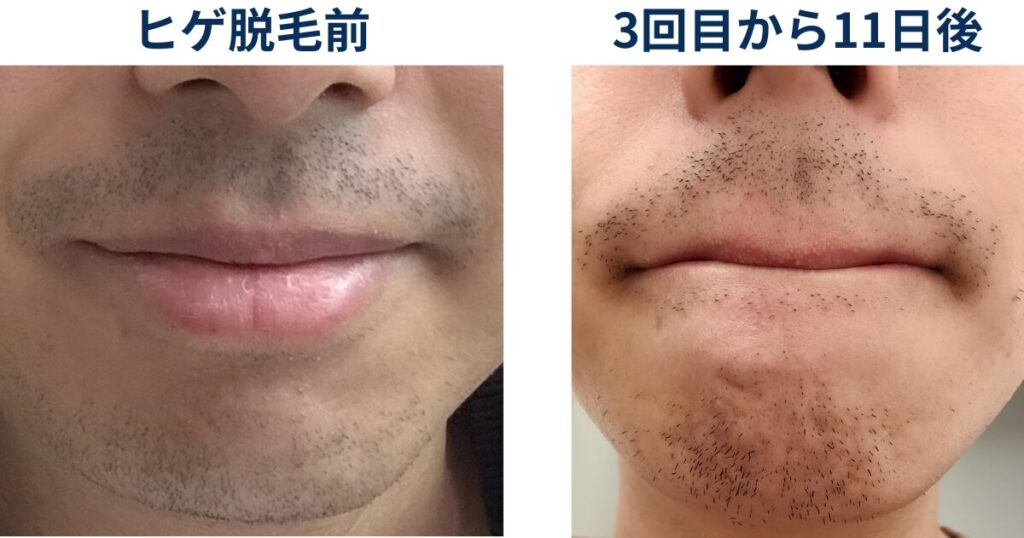 ヒゲ脱毛を始める前と3回目の直後でヒゲがどのように変化しているか比較するイラスト