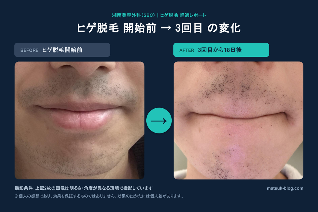 ヒゲ脱毛開始前と3回目から18日後の比較