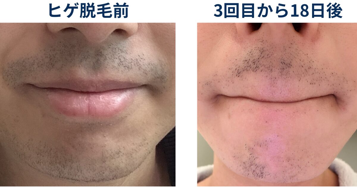 ヒゲ脱毛を始める前と3回目の直後でヒゲがどのように変化しているか比較するイラスト