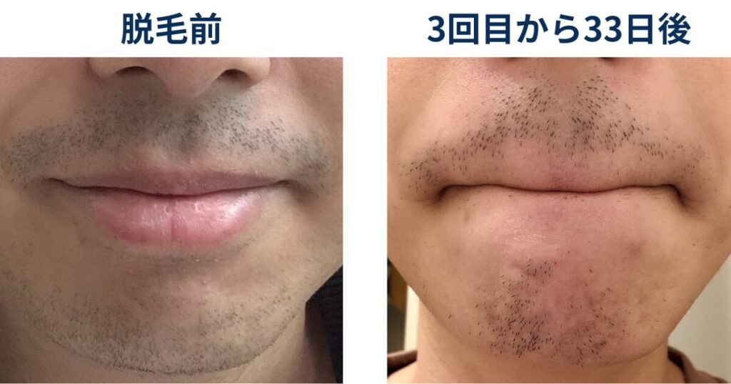 ヒゲ脱毛を始める前と3回目の33日後でヒゲがどのように変化しているか比較するイラスト