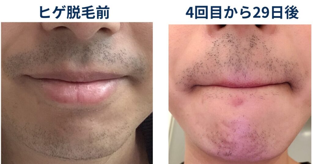 ヒゲ脱毛を始める前と4回目の29日後でヒゲがどのように変化しているか比較するイラスト