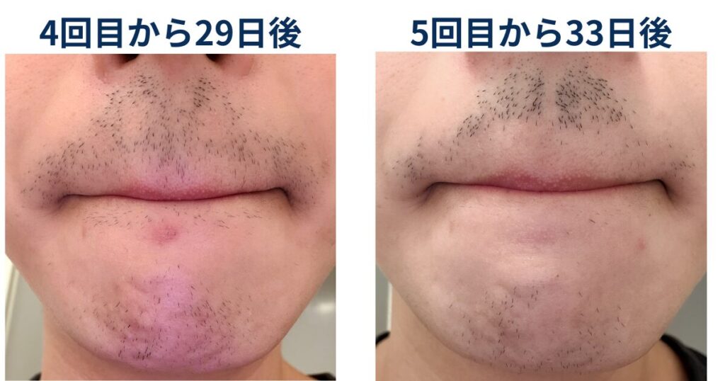 ヒゲ脱毛4回目の29日後と5回目の33日後の髭の生え方について比較したイラスト