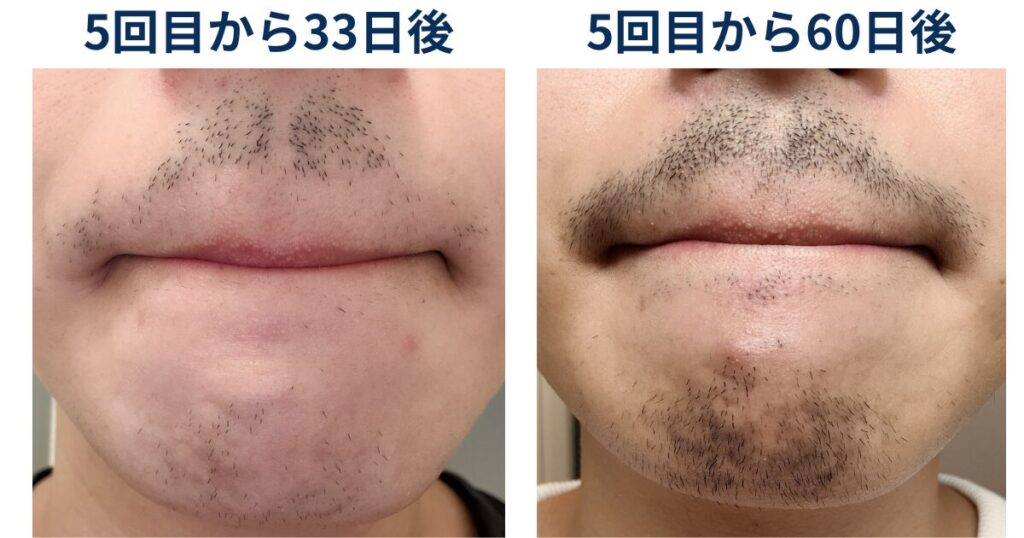 33日後/60日後ヒゲ脱毛の効果を比較