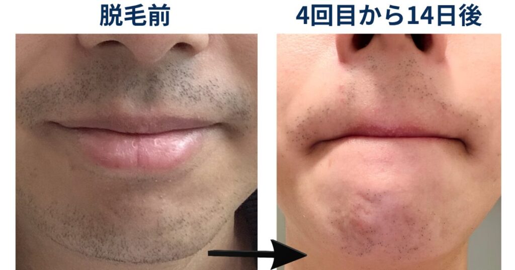 ヒゲ脱毛を始める前と4回目の14日後の髭の生え方について比較したイラスト