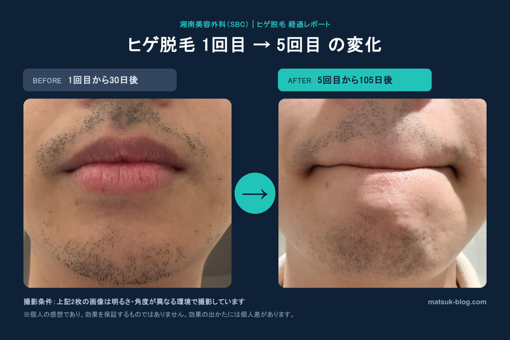 ヒゲ脱毛1回目から30日後と5回目から105日後を比較したヒゲの様子
