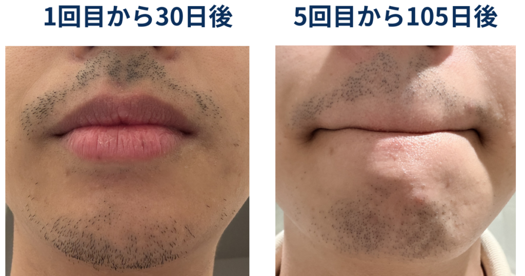 ヒゲ脱毛1回目の30日後と5回目の105日後の髭の生え方について比較したイラスト