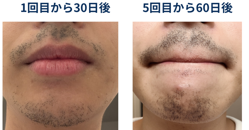 1回目から33日後/5回目から60日後ヒゲ脱毛の効果を比較