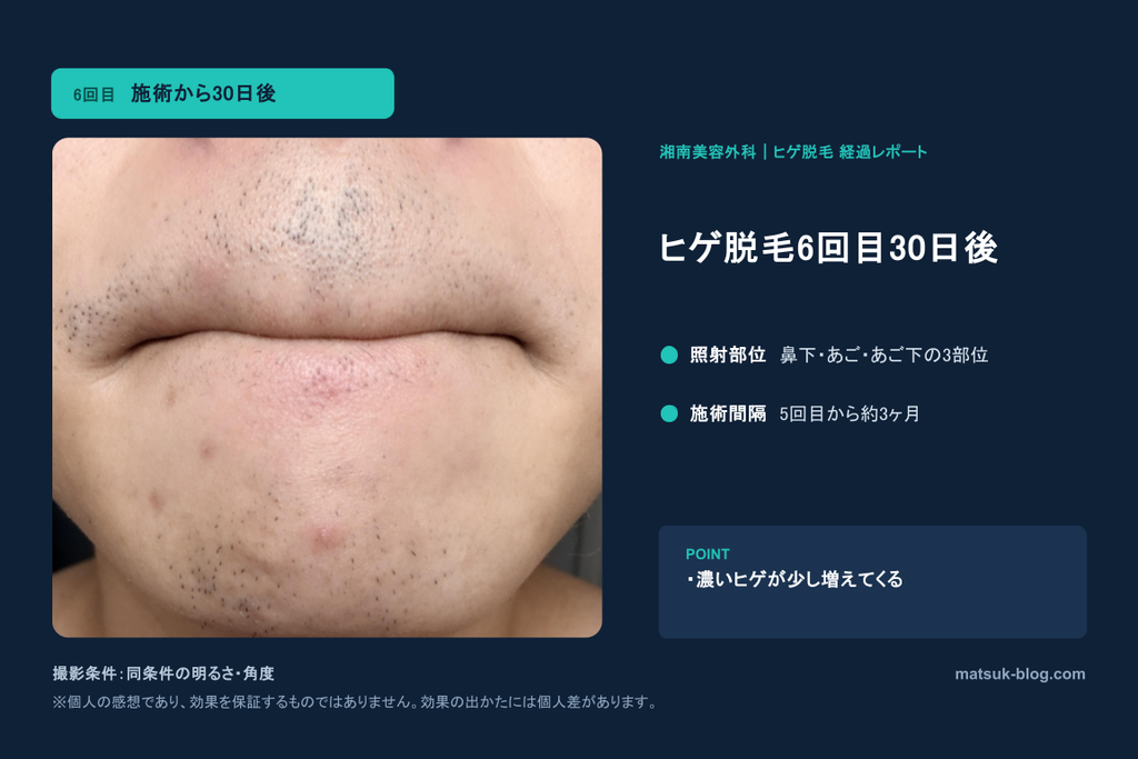 ヒゲ脱毛6回目から30日後のヒゲの様子