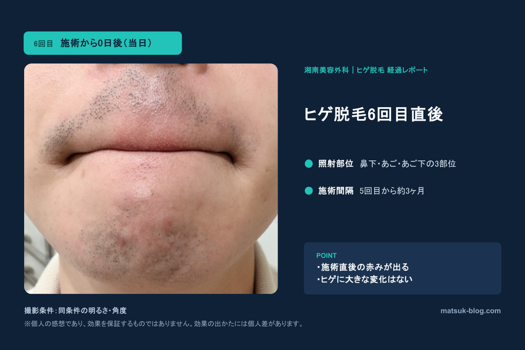 ヒゲ脱毛６回目。脱毛直後の様子