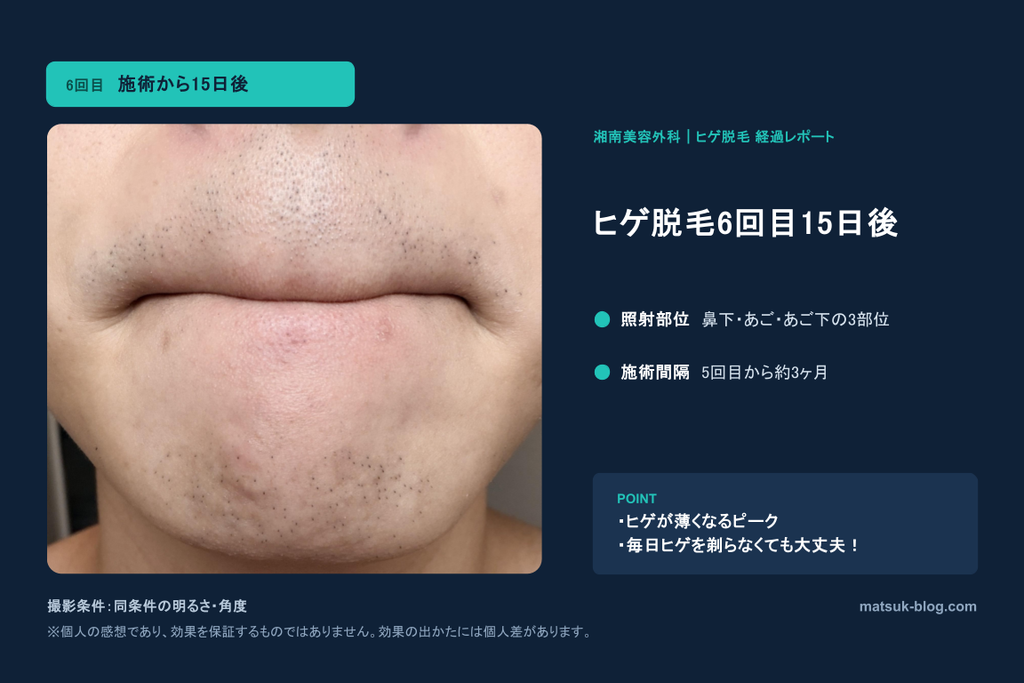 施術15日後のアゴ周り。もっともツルッとした状態