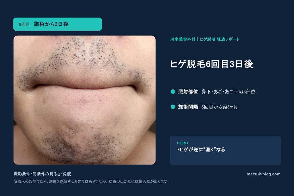 ヒゲ脱毛６回目から３日後にヒゲが濃くなる時期