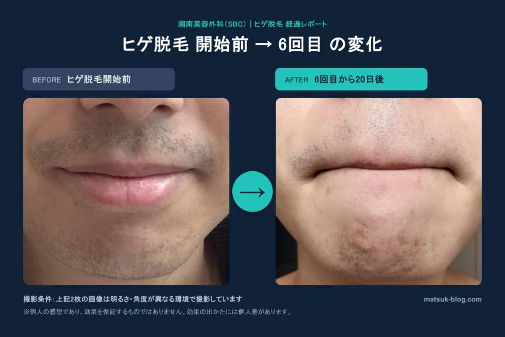 ヒゲ脱毛開始前と6回目から20日でヒゲがどのように変化したかを比較