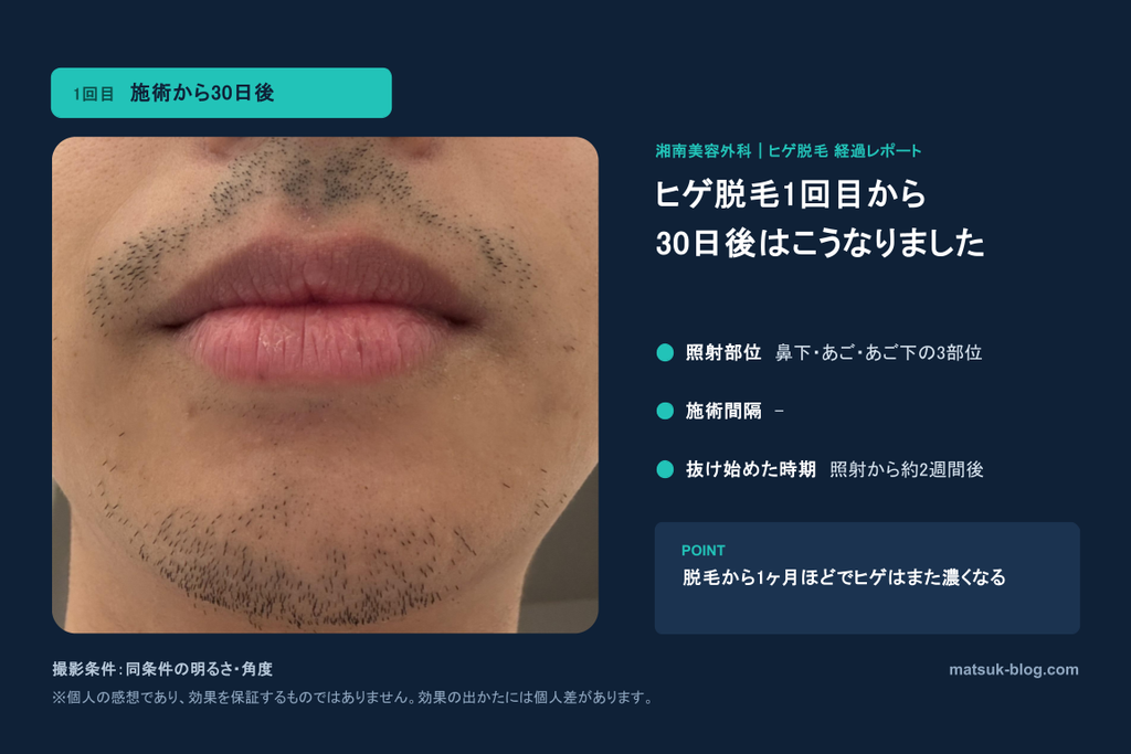 ヒゲ脱毛1回目から30日後の様子。ヒゲの濃さは元に戻った。
