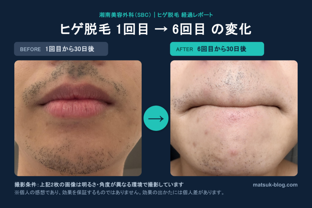 ヒゲ脱毛1回目から30日後と6回目から30日後の比較。ヒゲの生え方がどう変わったか