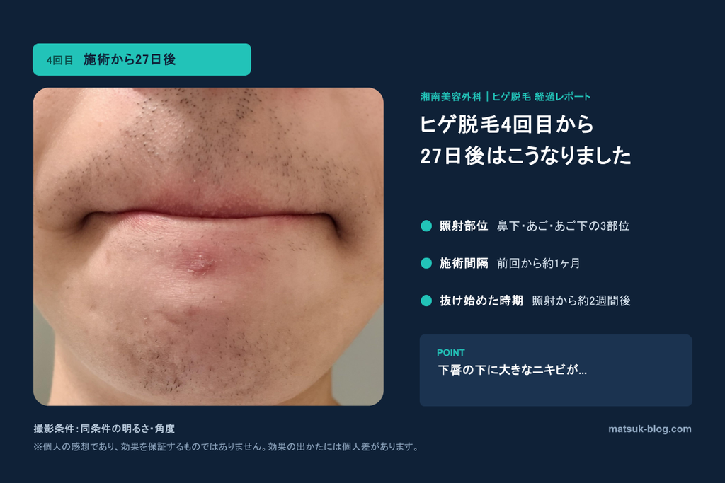 ヒゲ脱毛4回目から27日後。ニキビができた。