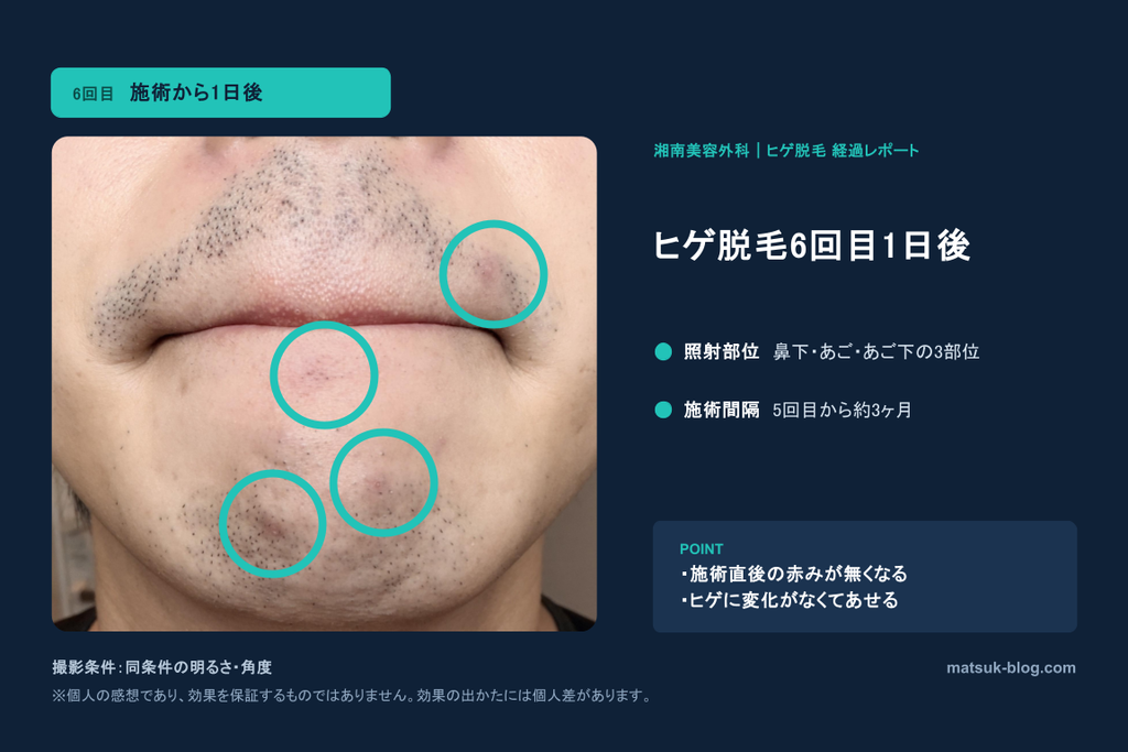 ヒゲ脱毛6回目1日後の画像。ニキビ跡が4個