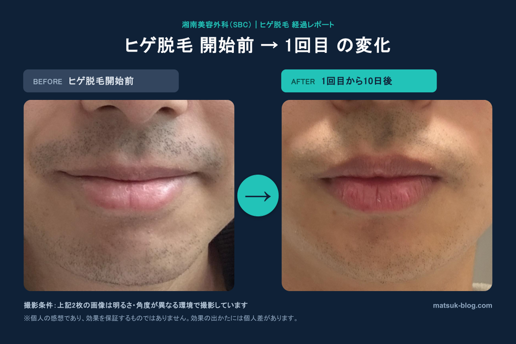 ヒゲ脱毛開始前と1回目から10日後を比較。青髭が目立たなくなった